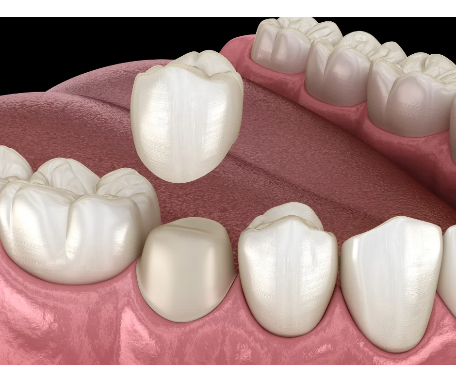 Dental crown — restorative dentistry