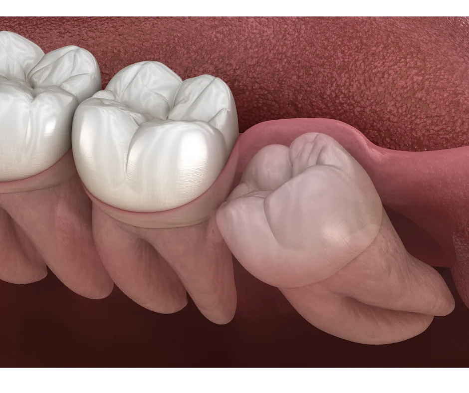 Tooth extraction