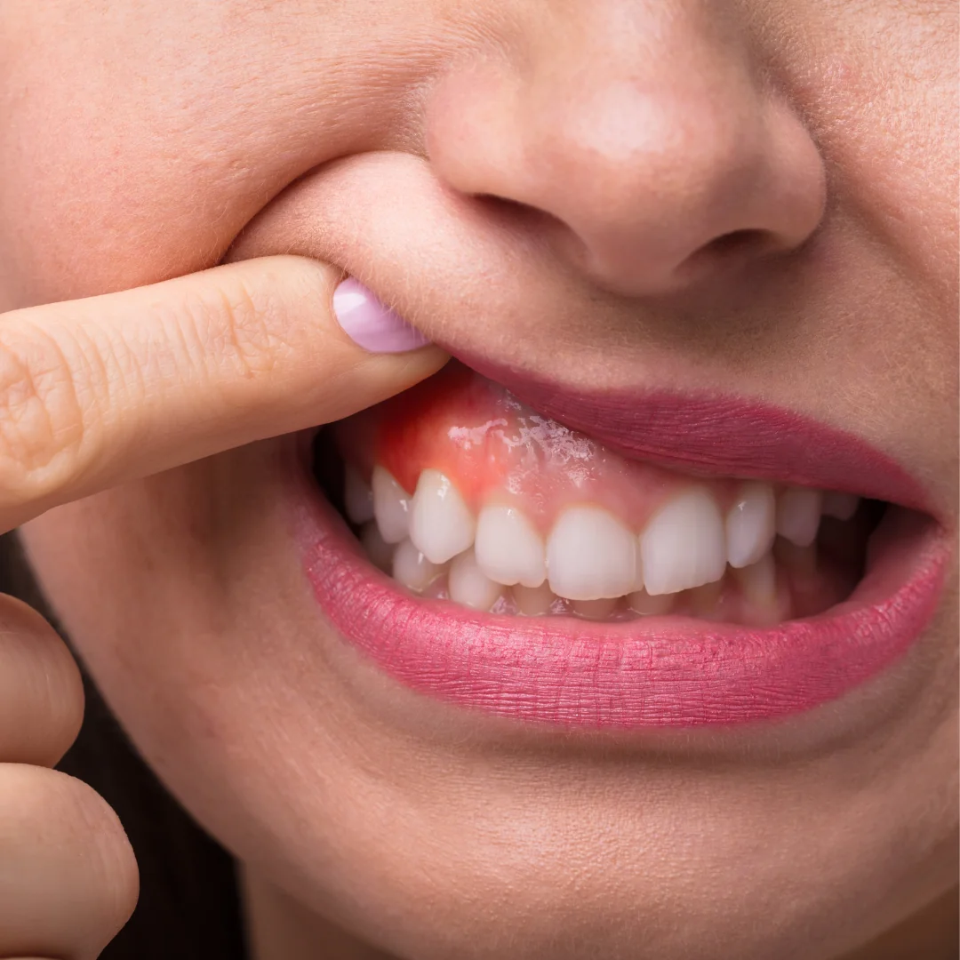 Periodontal treatment